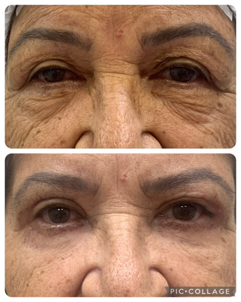 RESULTADOS - BLEFAROPLASTIA (4)