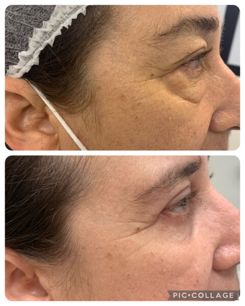 RESULTADOS - BLEFAROPLASTIA (7)