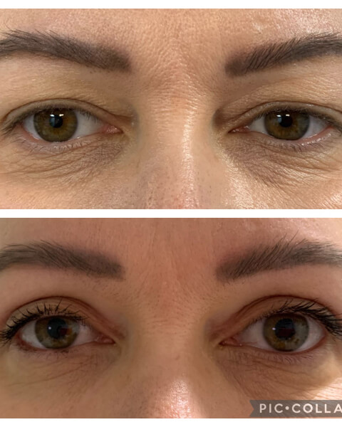 RESULTADOS - BLEFAROPLASTIA (9)